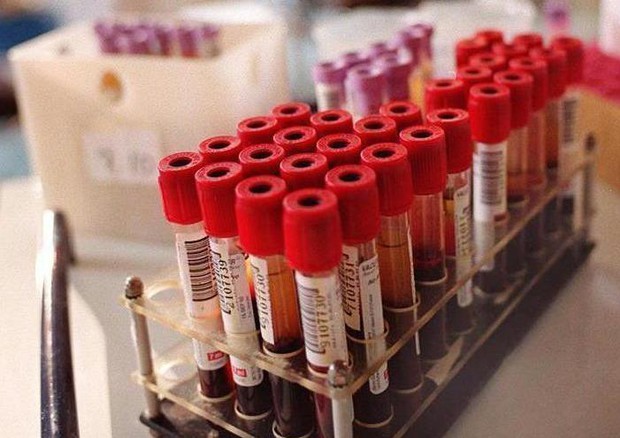 Epilessia, prelievo sangue rivela risposta bimbi a farmaci © ANSA