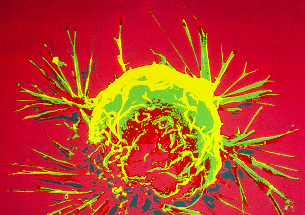I tumori hanno un 'freno' naturale, che azionano in casi particolari per bloccare la crescita delle loro stesse metastasi (fonte: NIH Image Gallery) © Ansa