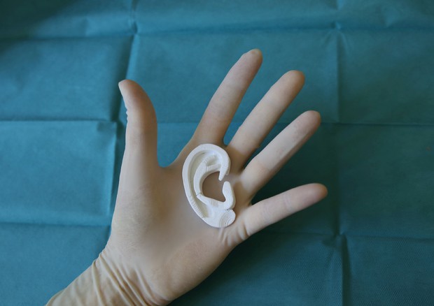 Il modello dell'orecchio al Meyer ricostruito in 3D ad un bambino nato senza padiglione © Ansa