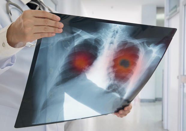 Tumore al polmone 'Alk', la diagnosi arriva dalla biopsia liquida © Ansa
