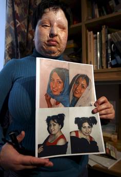  La giovane iraniana Ameneh Bahrami, che era stata accecata e sfigurata con l'acido da un uomo