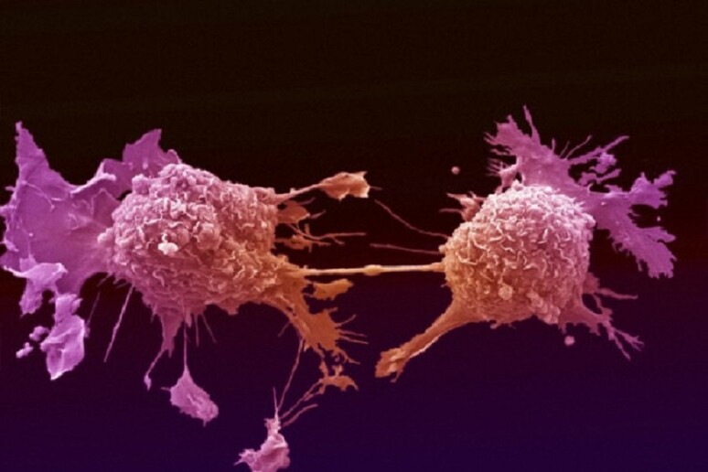 Cellule tumorali dei polmoni (fonte: Wellcome Images) - RIPRODUZIONE RISERVATA