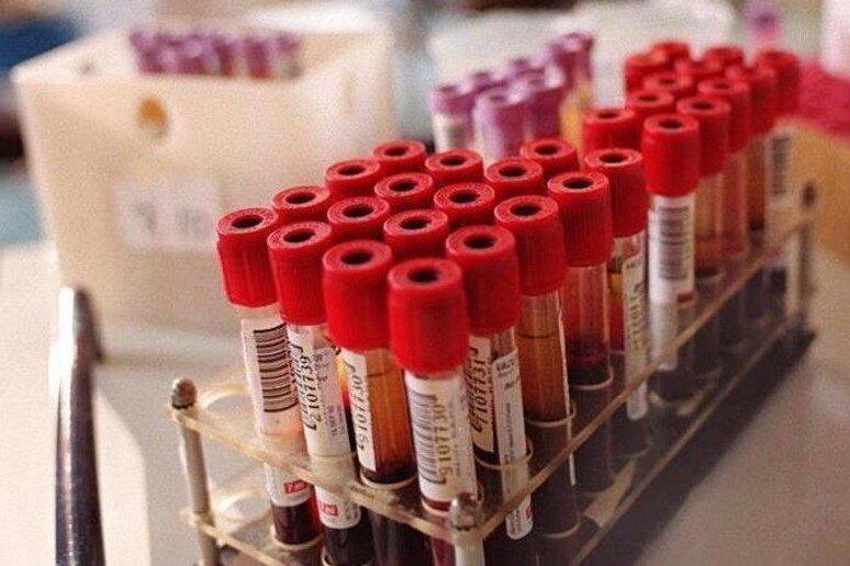 Epilessia, prelievo sangue rivela risposta bimbi a farmaci - RIPRODUZIONE RISERVATA