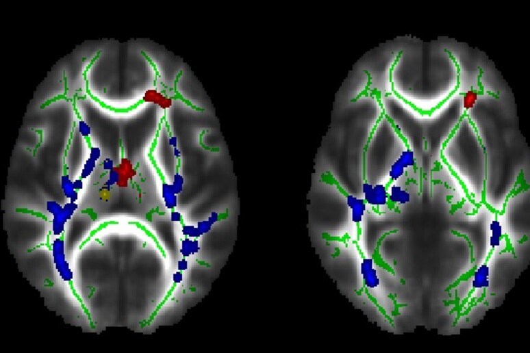 I fasci di sostanza bianca che presentano microalterazioni, evidenziate in blu e rosso (fonte: Journal: Psychiatry Research Neuroimaging, Elsevier) - RIPRODUZIONE RISERVATA