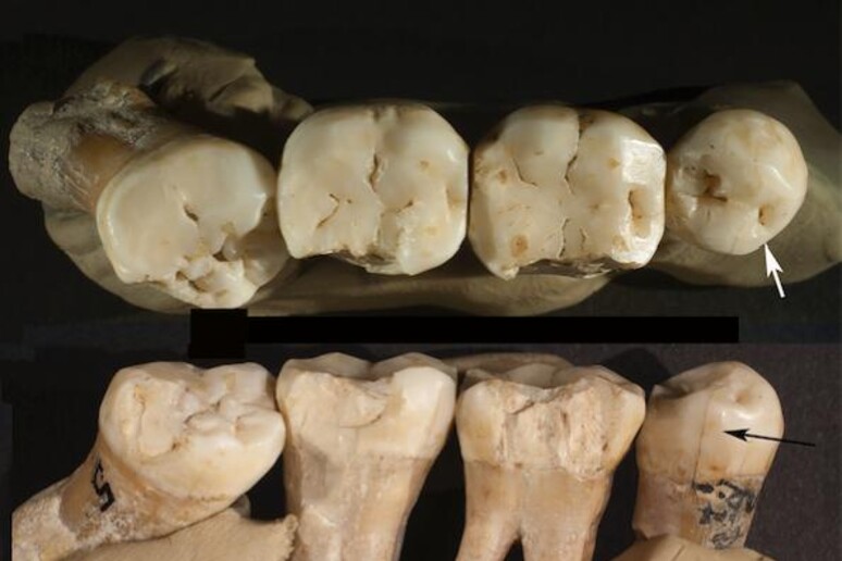 I denti fossili che, a distanza di 130.000 anni, conservano tracce di cure (fonte: David Frayer, University of Kansas) - RIPRODUZIONE RISERVATA