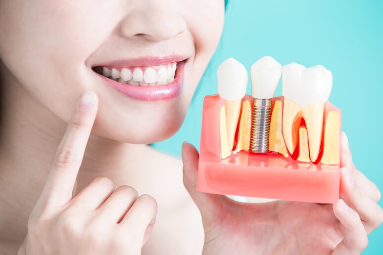 Impianti dentali possono ammalarsi come i denti veri - RIPRODUZIONE RISERVATA