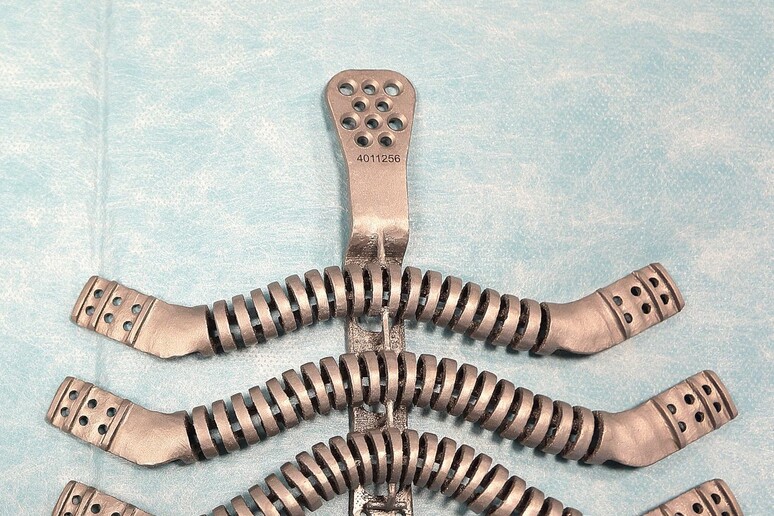 La protesi di sterno stampato in 3D - RIPRODUZIONE RISERVATA
