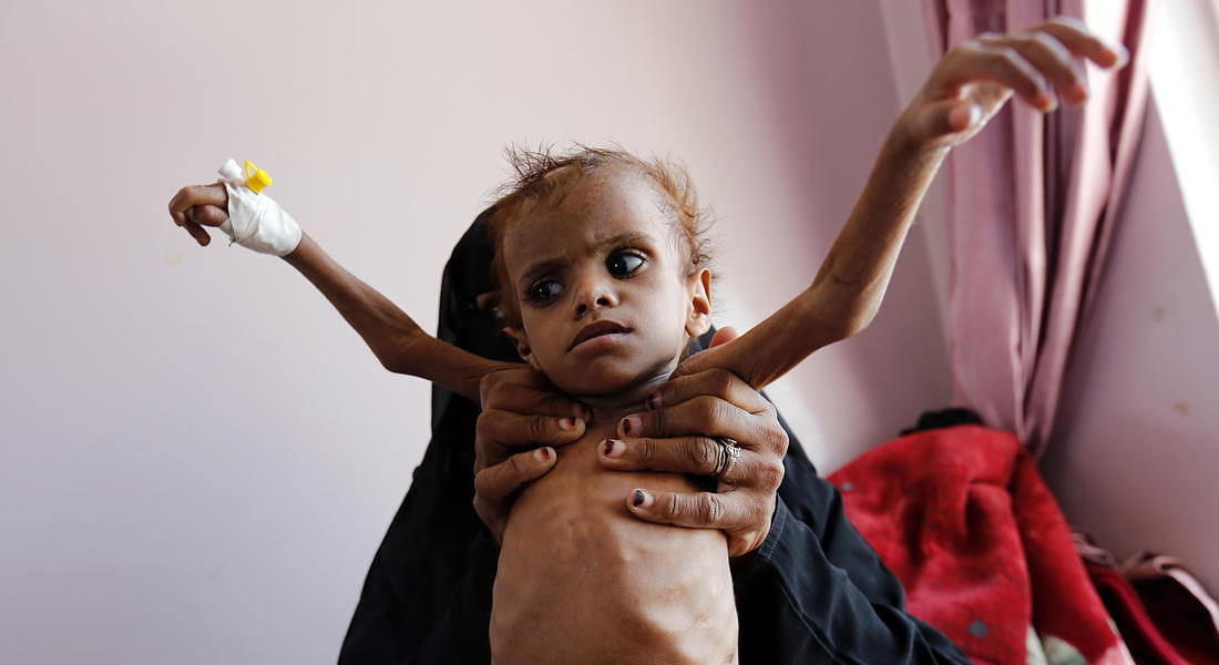 La crisi umanitaria nello Yemen, con l'infanzia malnutrita - 2018 © EPA