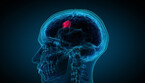 Per il tumore al cervello nuove terapie (ANSA)