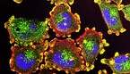 Cellule tumorali (fonte: Unsplash) (ANSA)
