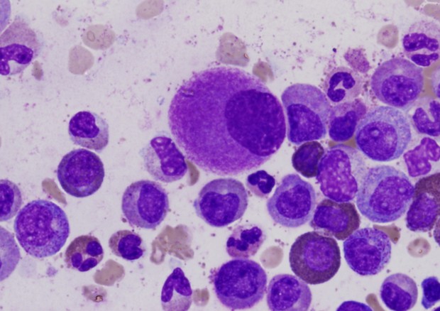Cellule del midollo colpite dalla leucemia (fonte: Difu Wu) © Ansa