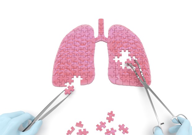 Tumore al polmone, obiettivo zero-chemio per il 50% dei malati © Ansa