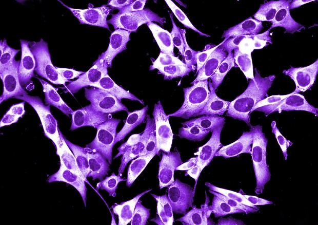 Farmaco comune contro ipertensione blocca crescita melanoma, nell'immagine le cellule del tumore © Ansa