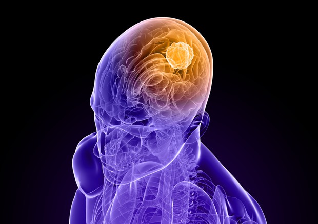 Aggressivo tumore cervello in provetta per cure su misura © Ansa