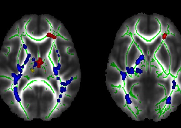 I fasci di sostanza bianca che presentano microalterazioni, evidenziate in blu e rosso (fonte: Journal: Psychiatry Research Neuroimaging, Elsevier) © Ansa