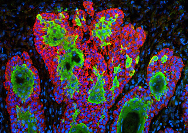 Cellule del tumore della pelle (fonte: Markus Schober e Elaine Fuchs, The Rockefeller University) © Ansa
