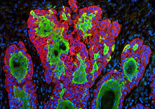 Cellule tumorali della pelle. Sono state uno dei primi bersagli dell'immunoterapia (fonte: Markus Schober e Elaine Fuchs, The Rockefeller University/NIH Image Gallery, Flickr) © Ansa