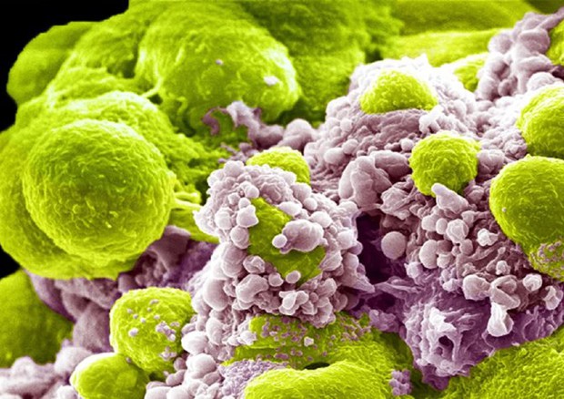 Cellule del tumore alla prostata (in verde), uno dei numerosi tumori che liberano cellule che raggiungono altre parti del corpo (fonte: Khuloud T. Al-Jamal & Izzat Suffian/Wellcome collection) © Ansa
