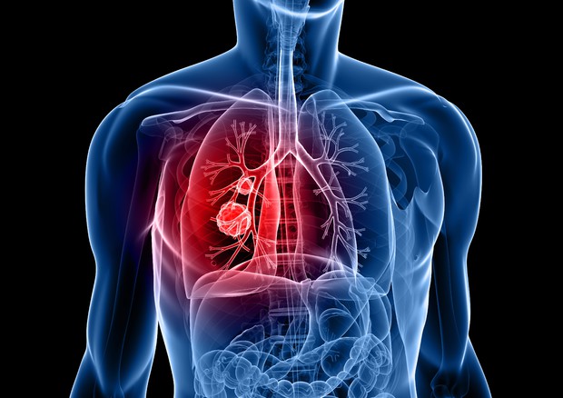 Tumore al polmone © Ansa