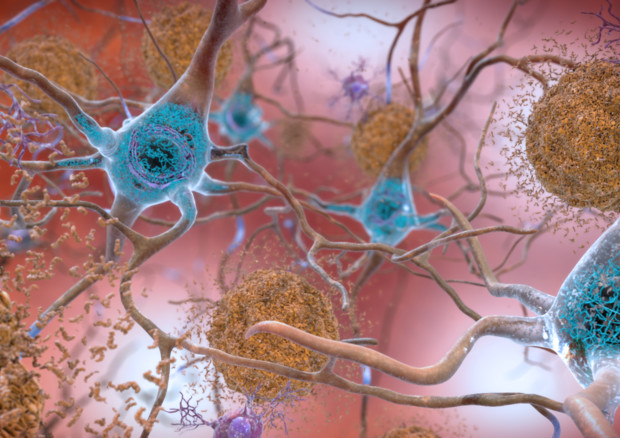 Le cellule nervose e le placche tipiche della malattia di Alzheimer (fonte: National Institute on Aging, NIH, Flickr) © Ansa