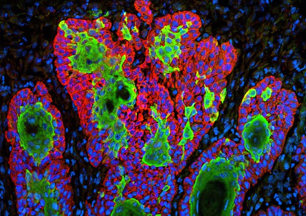 Cellule del tumore della pelle (fonte:  Markus Schober and Elaine Fuchs, The Rockefeller University, NIH, Flickr) © Ansa