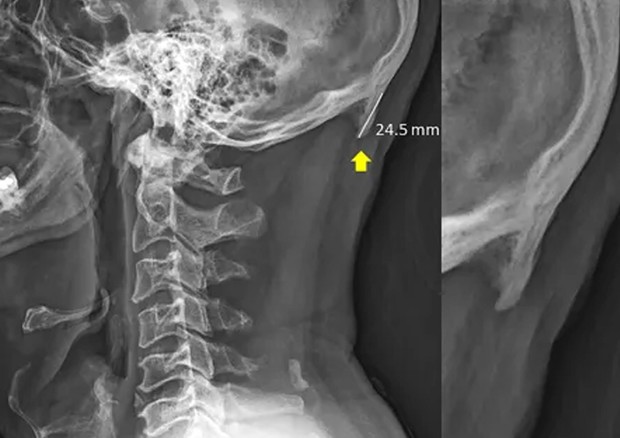 Le immagini radiografiche dello studio pubblicato su Scientific Reports sulla crescita di alcune ossa alla base del cranio © ANSA