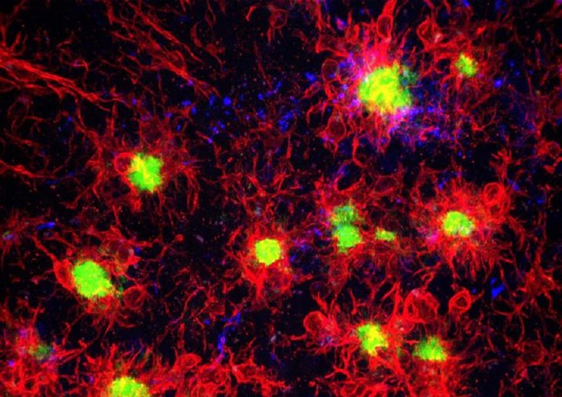 In rosso la microglia e in verde le placche di amiloide in un cervello con Alzheimer (fonte: Kim Green Lab/UCI) © Ansa