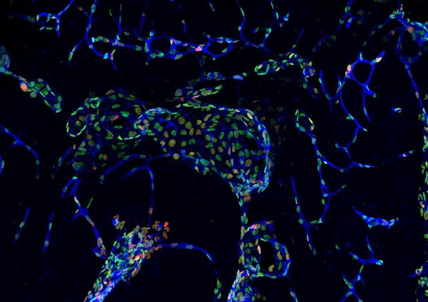 Colorazione istologica delle cellule endoteliali di un cavernoma cerebrale (fonte: Ifom-Università di Milano) © Ansa