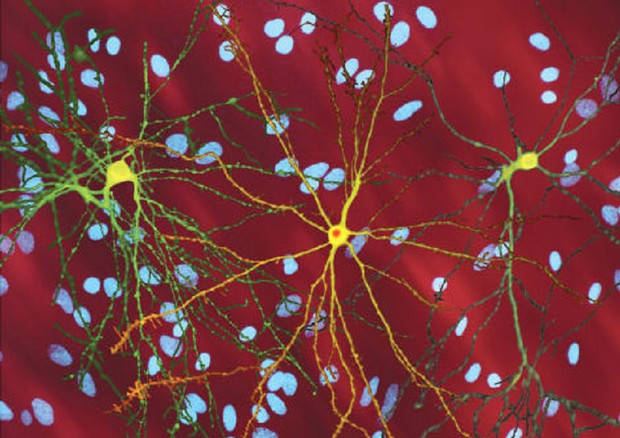 Neuroni colpiti dalla corea di Huntington (fonte: S. Finkbeiner, Gladstone Institute of Neurological Disease, The Taube-Koret Center for Huntington's Disease Research, e UCSF) © Ansa