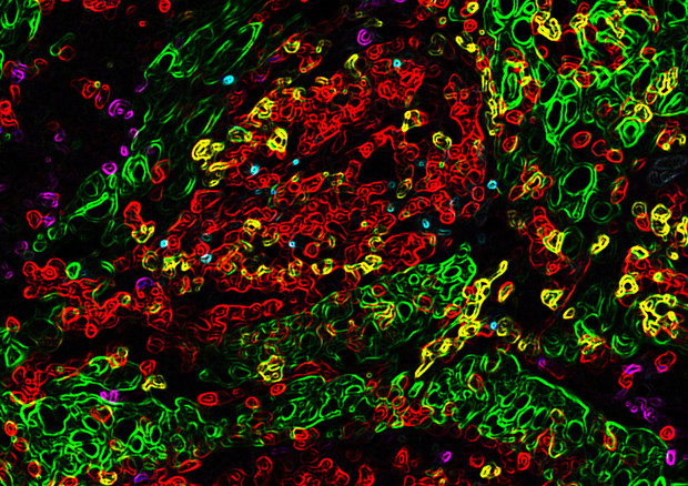 Microambiente del tumore del polmone (fonte: Romain Remark, Miriam Merad e Sacha Gnjatic Innate Pharma e Icahn School of Medicine, Mount Sinai) © Ansa