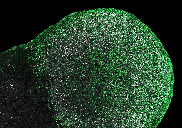 Il tumore cresciuto su un organoide cerebrale coltivato da cellule di un paziente affetto da sclerosi tuberosa (fonte: ©Knoblich/IMBA) © Ansa