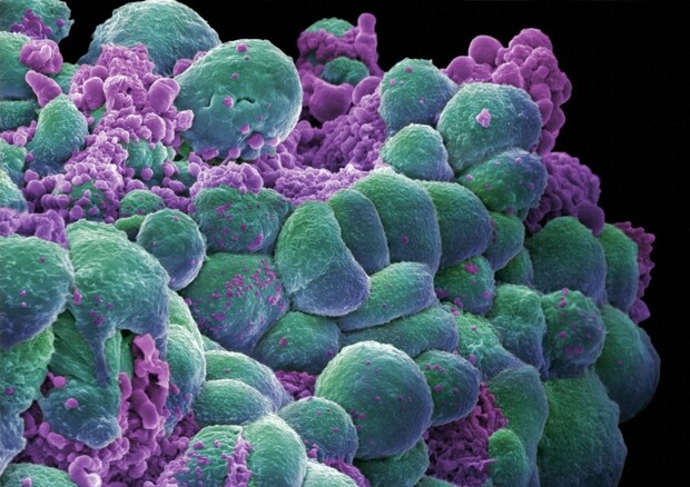 Cellule del tumore del seno (fonte: Annie Cavanagh. Wellcome Images, images@wellcome.ac.uk) © Ansa