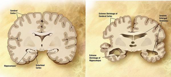 Alzheimer, raffronto tra un cervello sano e uno malato