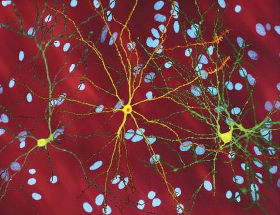 Neuroni di un soggetto colpito da Corea di Huntington (fonte: Dr. Steven Finkbeiner, Gladstone Institute, Taube-Koret Center and the University of California San Francisco)