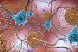 Le cellule nervose e le placche tipiche della malattia di Alzheimer (fonte: National Institute on Aging, NIH, Flickr)
