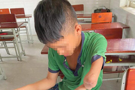 Perde uso del braccio,protesi 'firmata' a 14enne