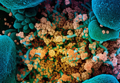 Particelle del virus SarsCoV2nsu una cellula (fonte: NIAID) (ANSA)