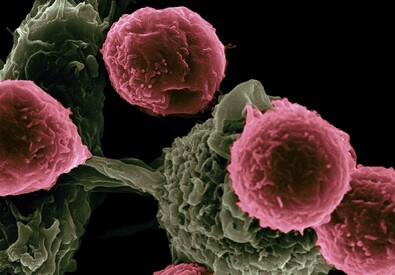 Cellule tumorali (fonte: National Cancer Institute da Unsplash) (ANSA)