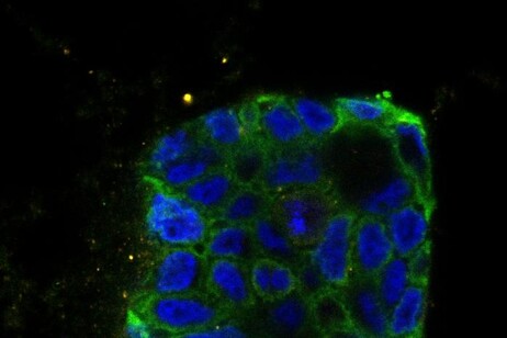 Organoide ottento dalle cellule di un paziente affetto da cancro al colon. (fonte: Netherlands Cancer Institute)