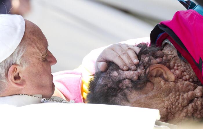 Man with deformed face who pope hugged dies