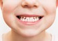 Digrignare i denti è uno dei sintomi nelle vittime di bullismo © ANSA