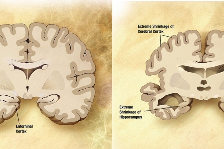 Alzheimer, raffronto tra un cervello sano e uno malato - RIPRODUZIONE RISERVATA