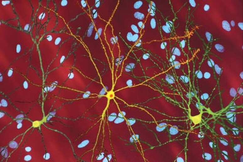 Neuroni di un soggetto colpito da Corea di Huntington (fonte: Dr. Steven Finkbeiner, Gladstone Institute, Taube-Koret Center and the University of California San Francisco) - RIPRODUZIONE RISERVATA