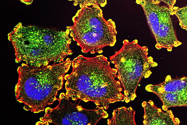 Cellule di melanoma (fonte: NIH) - RIPRODUZIONE RISERVATA