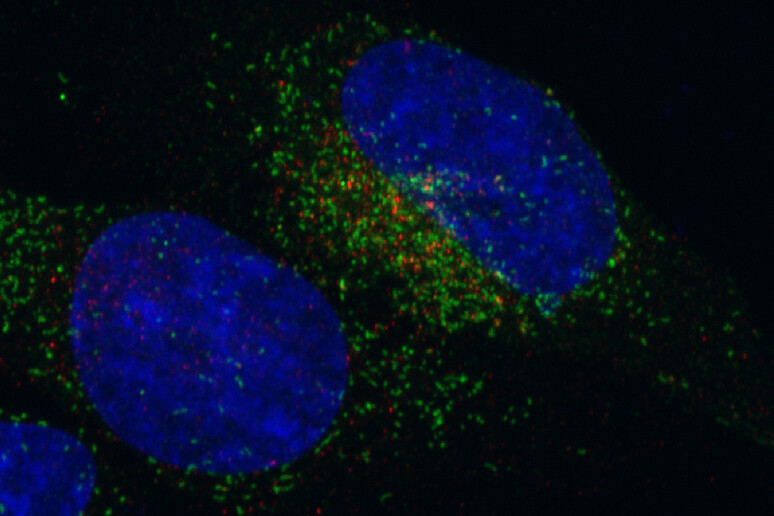 Una cellula tumorale portatrice della fusione genica FGFR3-TACC3 (fonte: Iavarone Lab, Columbia University Medical Center) - RIPRODUZIONE RISERVATA