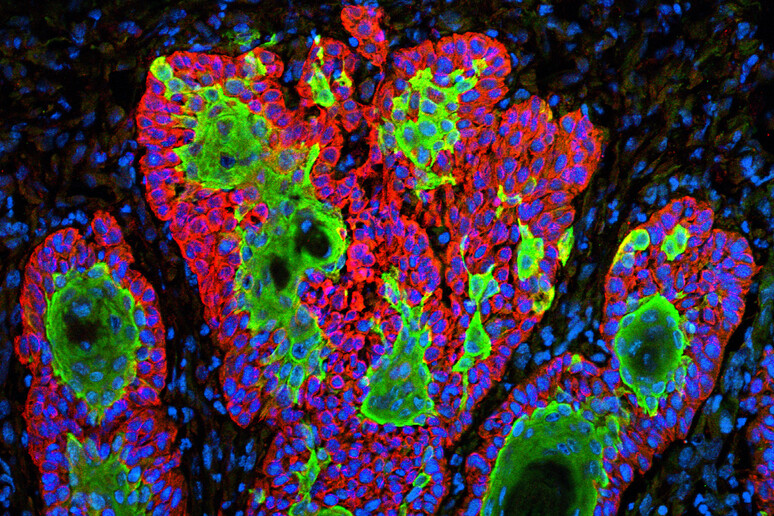 Cellula tumorale della pelle (fonte: NIH) - RIPRODUZIONE RISERVATA