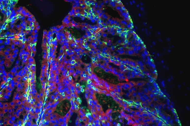Cellule del tumore della prostata (fonte: Davide Ruggero, università della California a San Francisco) - RIPRODUZIONE RISERVATA