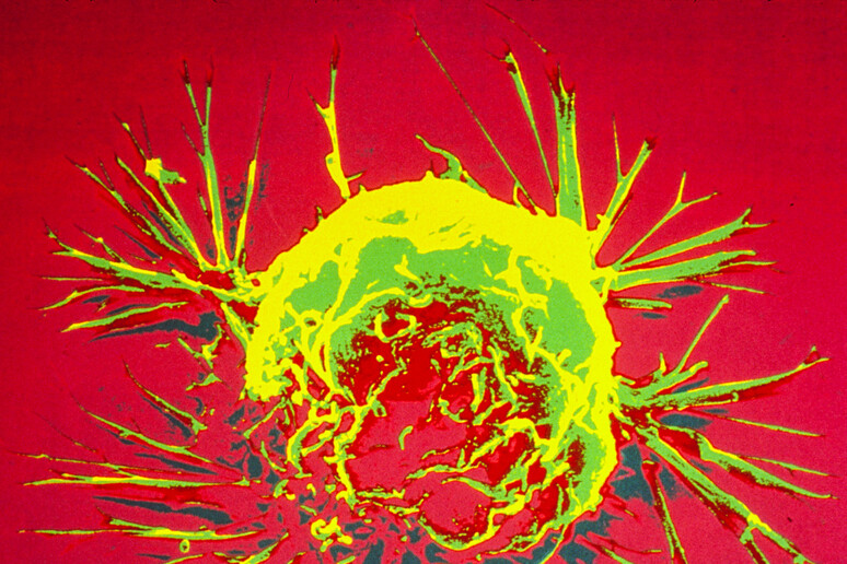 I tumori hanno un  'freno ' naturale, che azionano in casi particolari per bloccare la crescita delle loro stesse metastasi (fonte: NIH Image Gallery) - RIPRODUZIONE RISERVATA