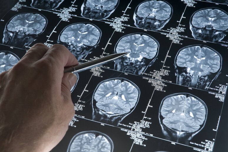 In Francia: test clinici  'selvaggi ' su malati di Alzheimer - RIPRODUZIONE RISERVATA