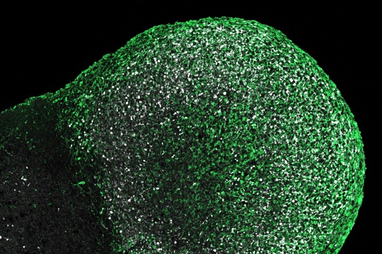 Il tumore cresciuto su un organoide cerebrale coltivato da cellule di un paziente affetto da sclerosi tuberosa (fonte: ©Knoblich/IMBA) - RIPRODUZIONE RISERVATA
